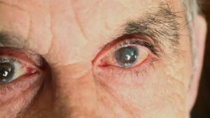 Glaucoma: Don't Ignore These Early Warning Signs & Know Your Risk
