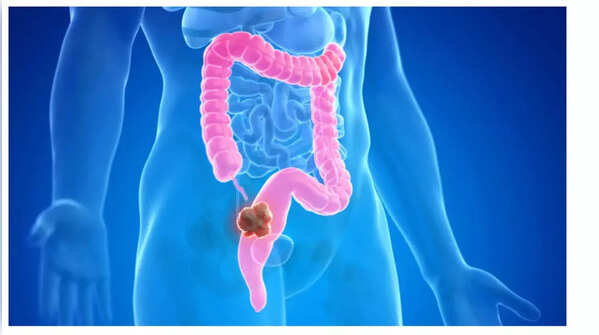 Unintentional weight loss, a potential indicator of colon cancer