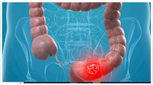 Person experiencing abdominal discomfort, a possible colon cancer symptom