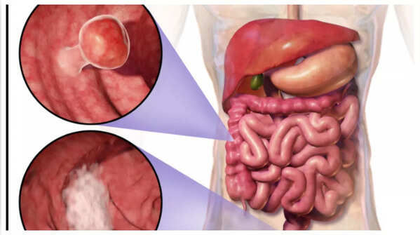 Close-up of blood in stool, a potential colon cancer sign